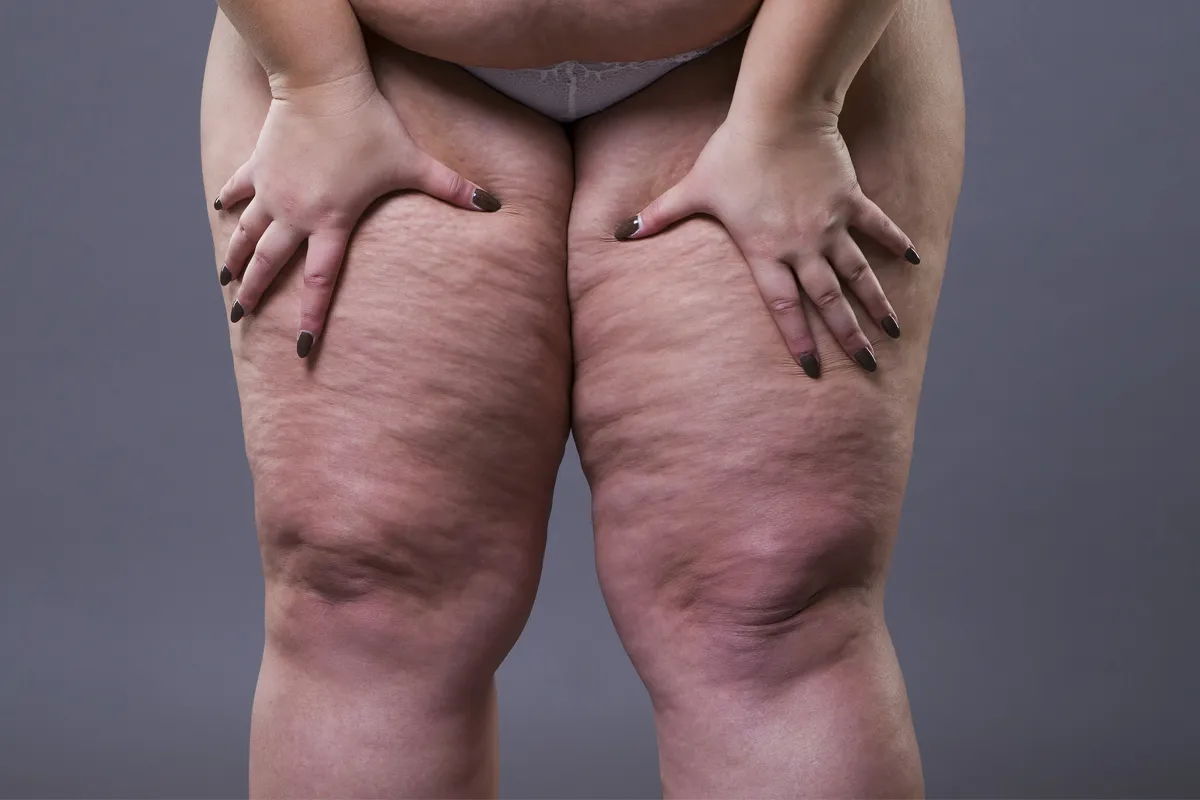 Lipedema ou obesidade? Como saber a diferença?